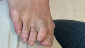 Bunions
